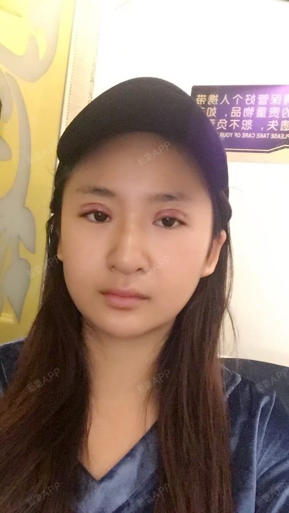 双眼皮刚做的全切,你们觉得宽不宽呀,太怕恢复好也是_圈子-新氧美容