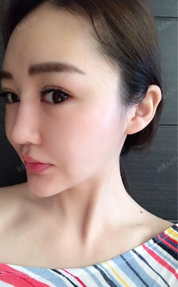 做完线雕隆鼻将近二十天了,感觉鼻子比刚做的时候低了_圈子-新氧美容