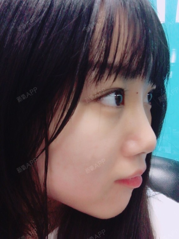 埋线隆鼻好不好_效果图_一脸懵逼666埋线隆鼻术后第7天_新氧美容整形