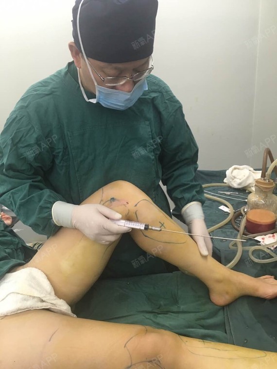 大腿吸出的脂肪,共吸出3000cc,装了3罐 现在腿和屁股感觉到酸胀,倒是