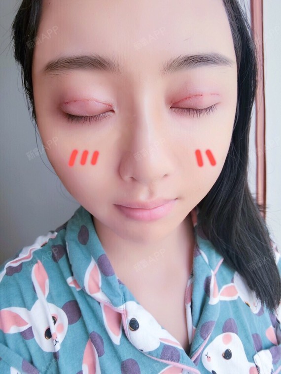 广州定点双眼皮好不好_效果图_晴天littlestar定点双眼皮术后第0天