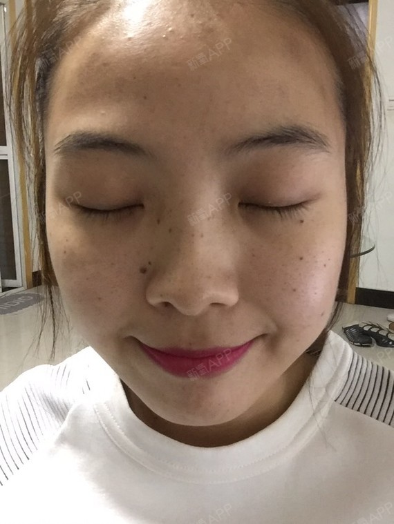 顶着王麻子脸出街了~完全没有结痂的意思啊~非常害怕_圈子-新氧美容