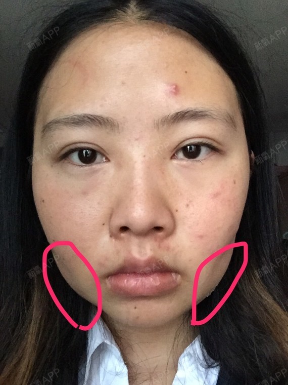 取颊脂垫瘦脸好不好_效果图_执取颊脂垫瘦脸术后第0天_新氧美容整形