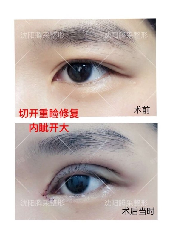 切开重睑内眦开大术后即刻效果 还您动人 魅惑电眼