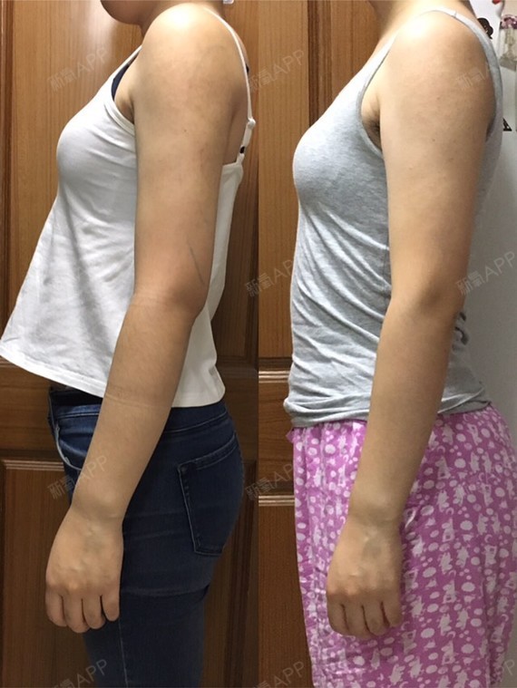 吸脂瘦手臂好不好_效果图_氧气ssn205b吸脂瘦手臂术后第19天_新氧美容
