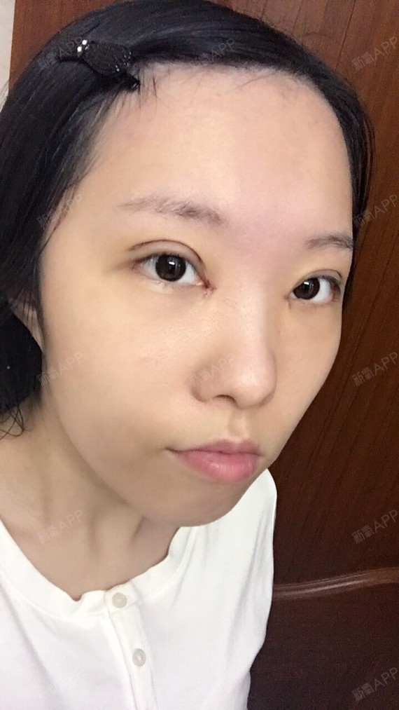 萌萌哒车厘子开内眼角第7天美丽日记