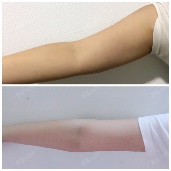 武汉吸脂瘦手臂好不好_效果图_彼此相爱526638吸脂瘦手臂术后第20天