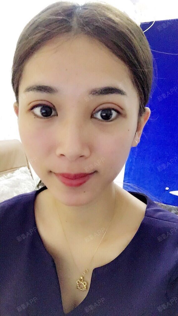 了,这是我从小到大的梦想,身边陆陆续续接触了很多割双眼皮的漂亮女生