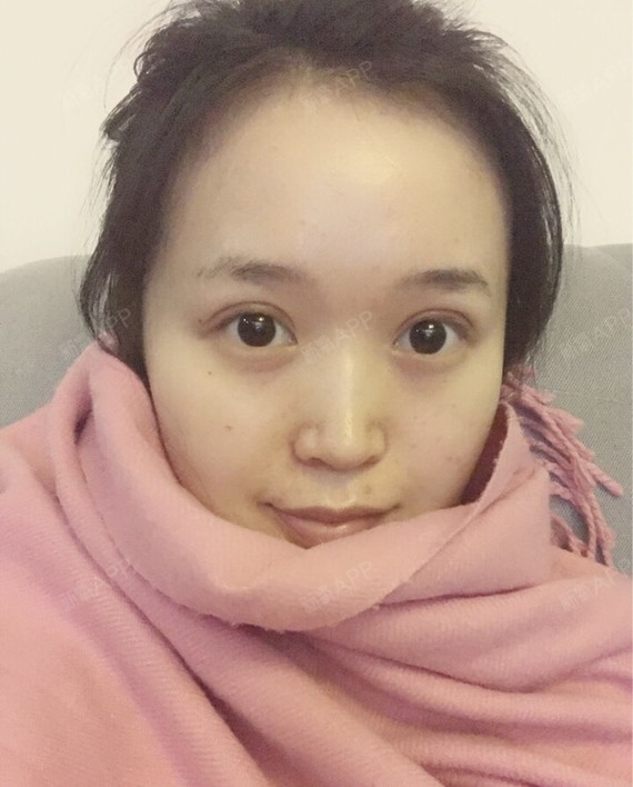 一年多前做过一次埋线双眼皮,做的挺自然的小窄双,当_圈子-新氧美容