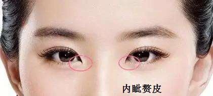 开不开内眼角?参考这个标准!