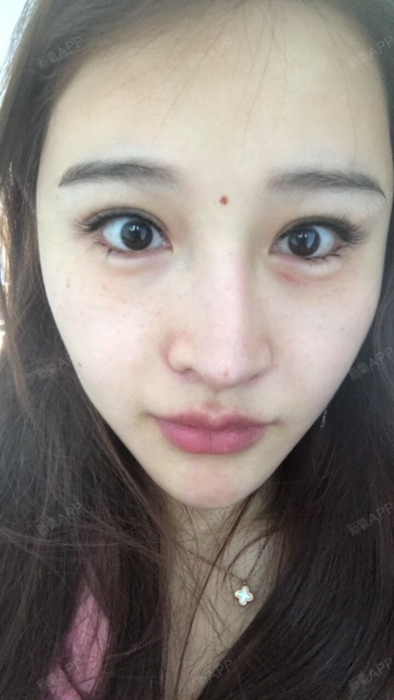 我来分享了 最近打了卧蚕 眼睛有点肿 哎呦 上瘾了 天天看自己不顺眼