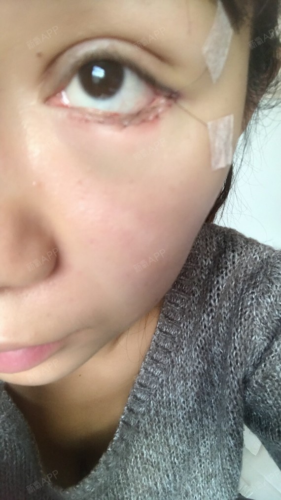 让生命美美哒开外眼角术后第天美丽日记_新氧整形