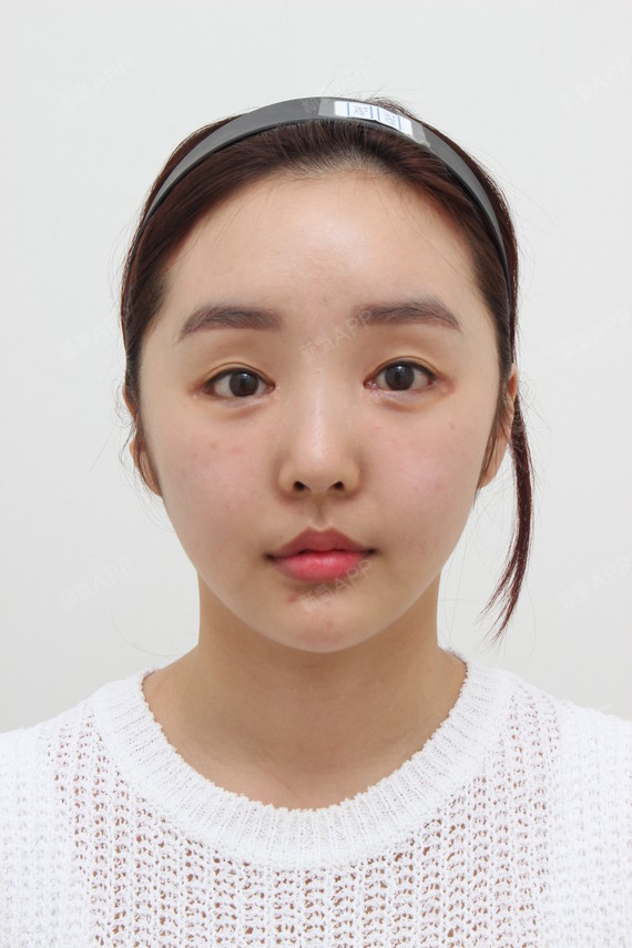 面部吸脂好不好_效果图_ruxiaoyi面部吸脂术后第270天_新氧美容整形