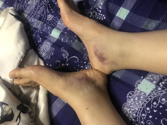 最肿的是第三,四天,到了一周抽脂部位的痛感基本可以忽略了,胸可能是