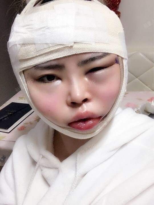 首尔下颌角整形好不好_效果图_要美美哒啊下颌角整形术后第5天_新氧
