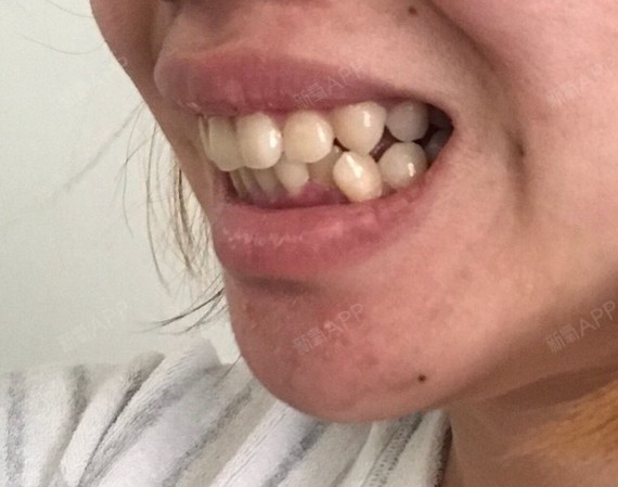 感觉牙齿比较大,但是侧面看上牙并没有特别向外凸起,_圈子-新氧美容