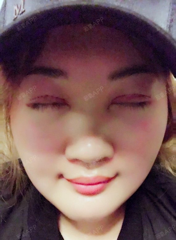 【全切双眼皮手术后第1天】