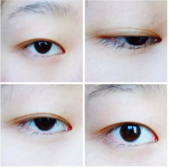 我以前就是小内双,和单眼皮没什么区别了,不化妆的时候眼睛