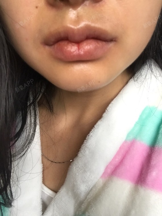 沙瓦迪卡m唇手术第36天美丽日记