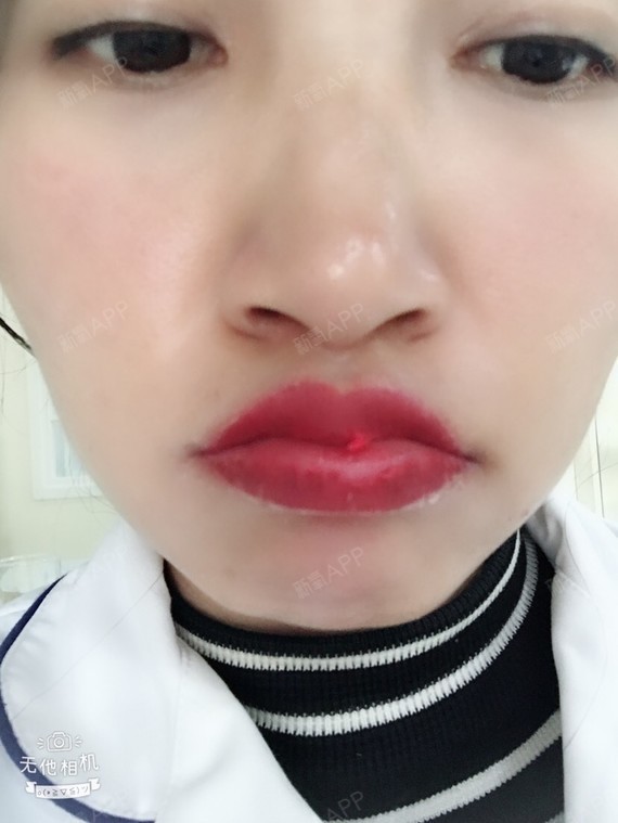 今天要给宝宝们分享一下漂唇的经历,我的唇色有一点点_圈子-新氧美容