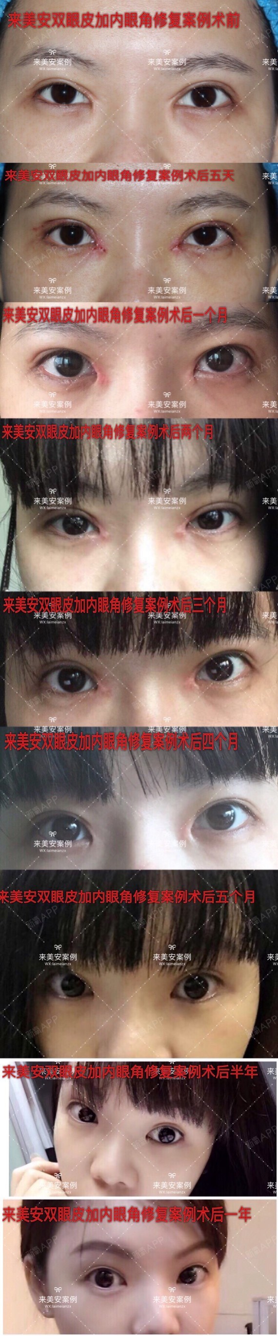 北京来美安眼整形修复医学研究院:来美安王恒美丽日记