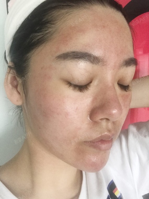 今天是在深圳颜美医疗做完微针的第2天,已经有点结痂_圈子-新氧美容