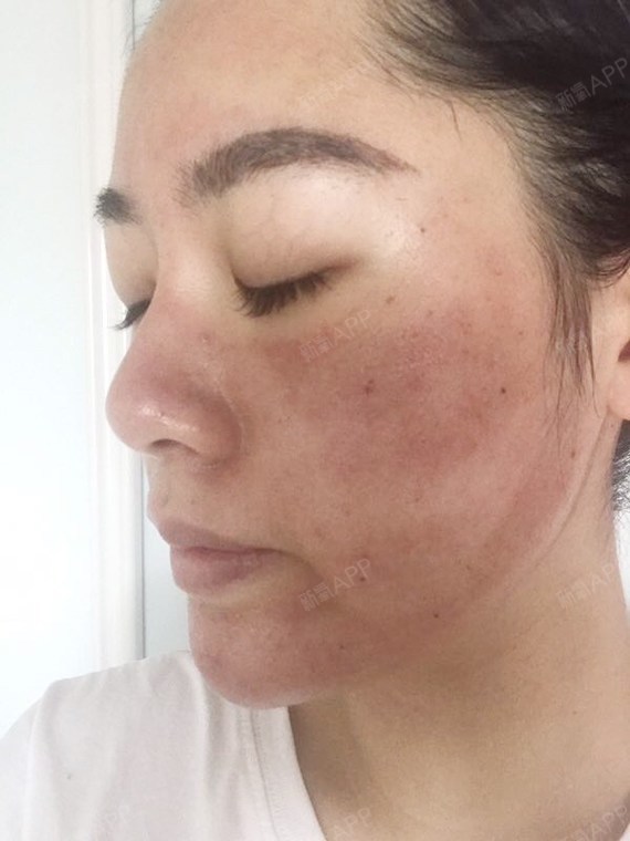 今天是在深圳颜美医疗做完微针的第2天已经有点结痂了很期待掉痂后的