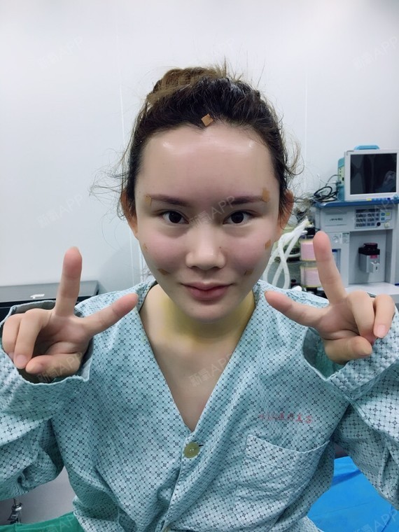 不问归期123自体脂肪全脸填充第215天美丽日记