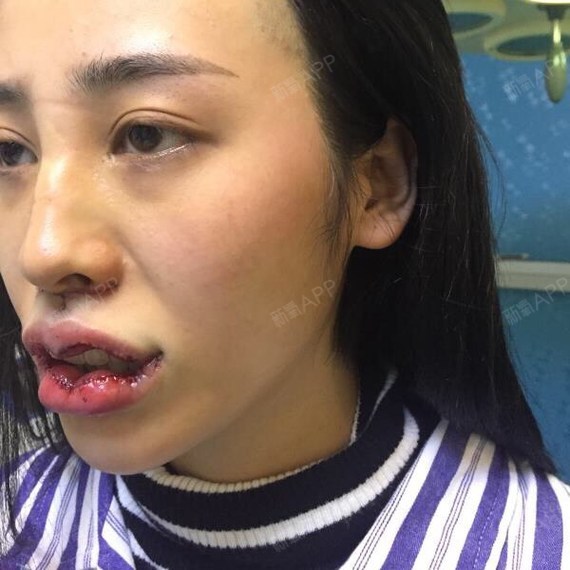 人中缩短术
