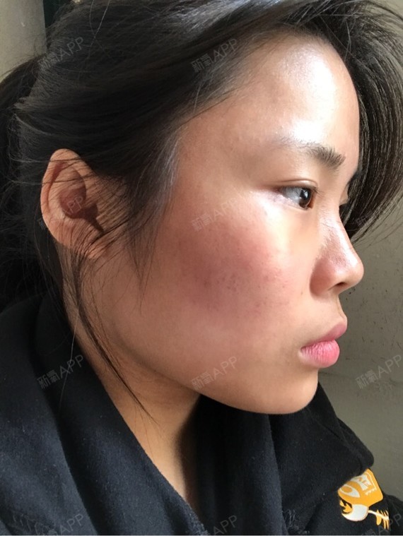 请问上颚凸怎么办啊?♀我的脸型还有得救吗?