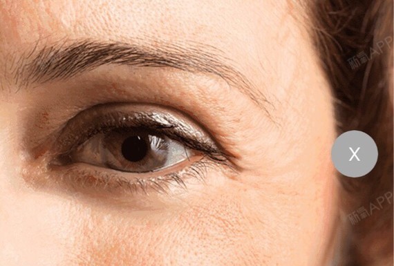 弹弹弹,真的能弹走鱼尾纹?为什么会长鱼尾纹?1,皮_圈子-新氧美容整形