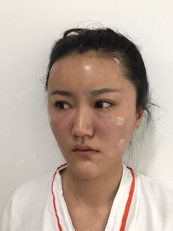 我的面中部凹陷比较严重泪沟很明显又没有苹果肌整个脸_圈子-新氧美容