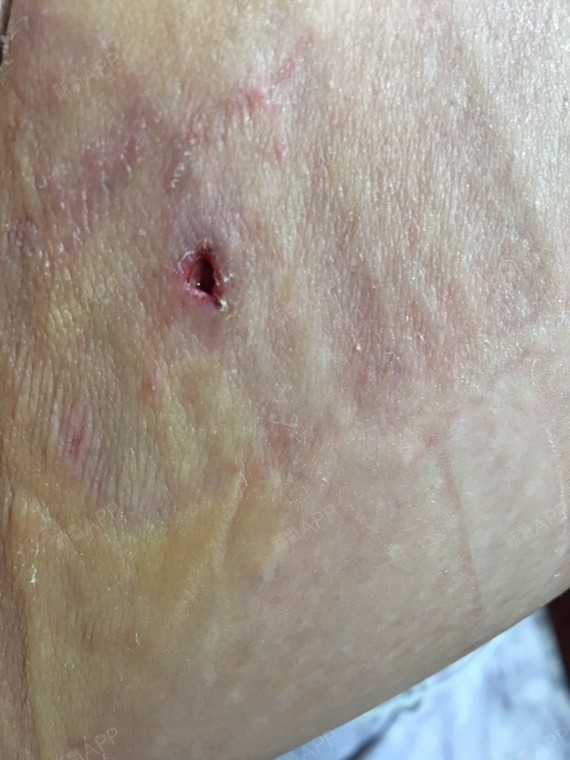怎么办?自体脂肪丰胸大腿一侧拆线后有个洞