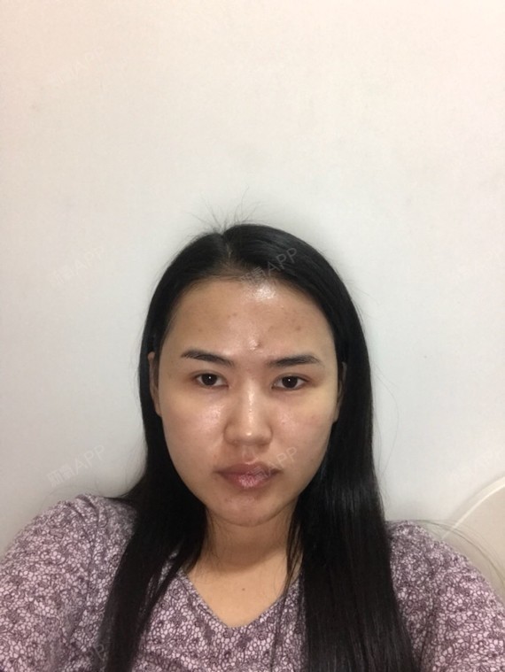 脂肪填充全脸失败,术后已经121天了,将近四个月了_圈子-新氧美容整形