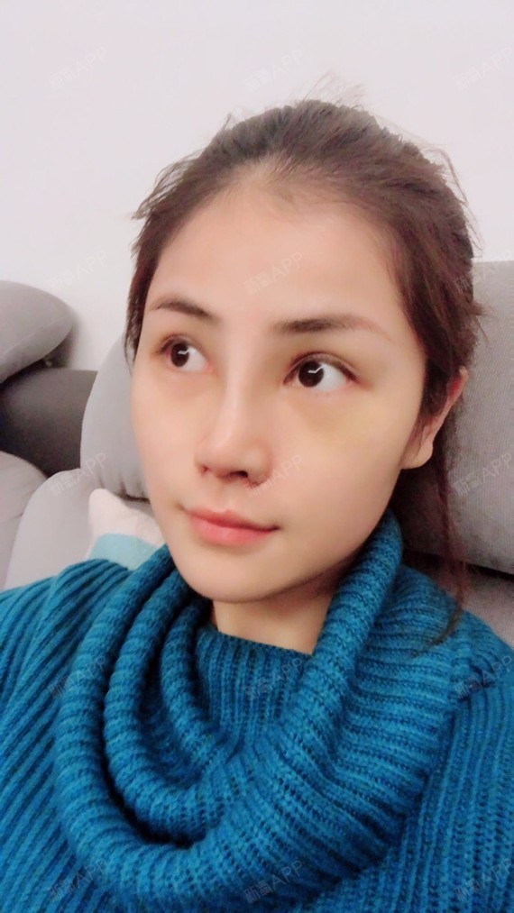 大车厘子鼻综合第10天美丽日记