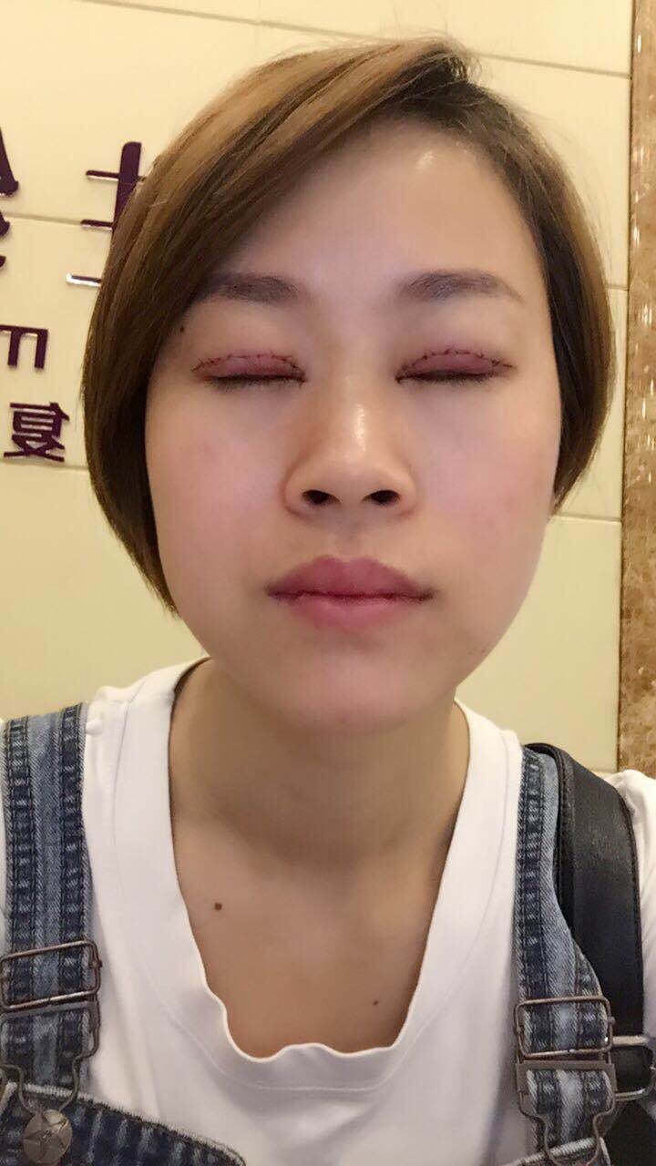 【切开双眼皮第0天】先来张手术当天包着纱布的照片.