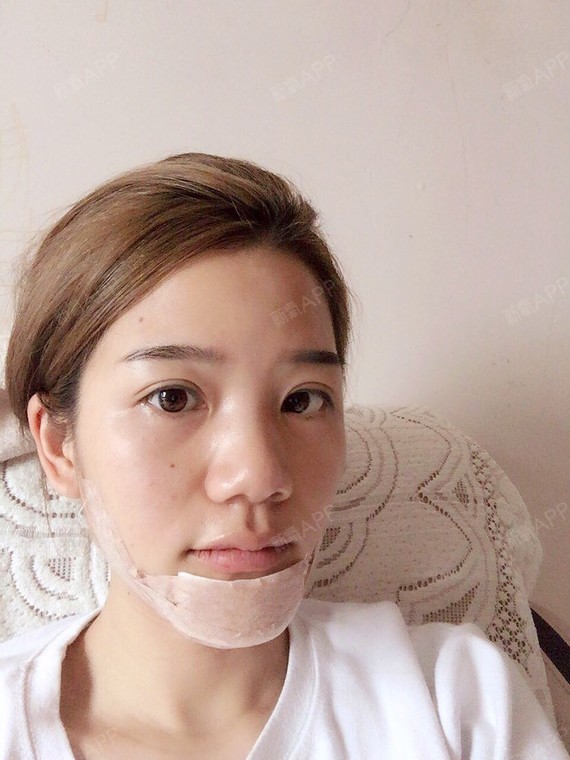 【韩式生科假体隆下巴】【手术专家:田毅博士】我朋友_圈子-新氧美容