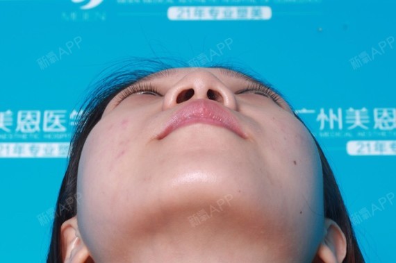 【隆鼻会使鼻孔增大吗?】