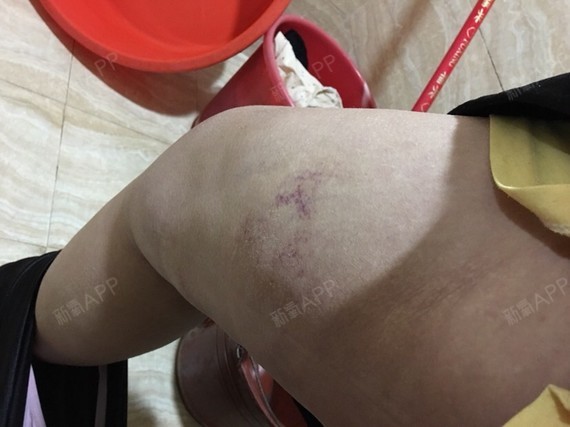 之前的淤青大部分自己消了,还剩一点吧.