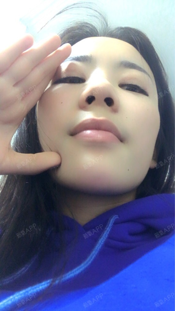 武汉手术缩鼻翼好不好_效果图_111_405769手术缩鼻翼术后第126天_新氧