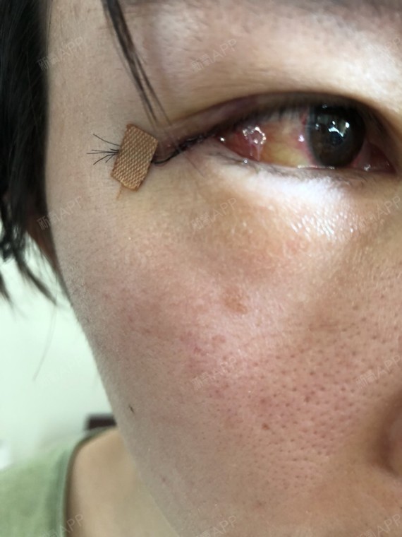 但是眼膜还是充血有点眼角膜水肿还是咋的,看着怪瘆人.