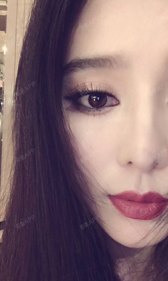 因为法令纹太深填充玻尿后仍有印记怎么办