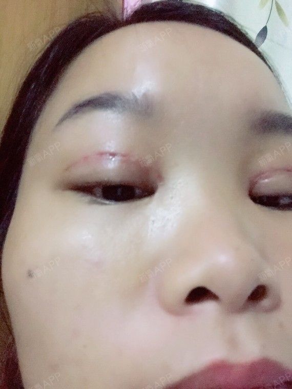 喜欢吴亦凡的同学开内眼角第7天美丽日记
