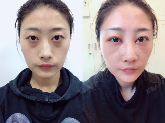 dy姐姐内切去眼袋第2天美丽日记