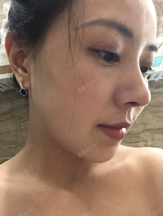 首尔鼻综合好不好_效果图_江南小猪宝鼻综合术后第145天_新氧美容整形