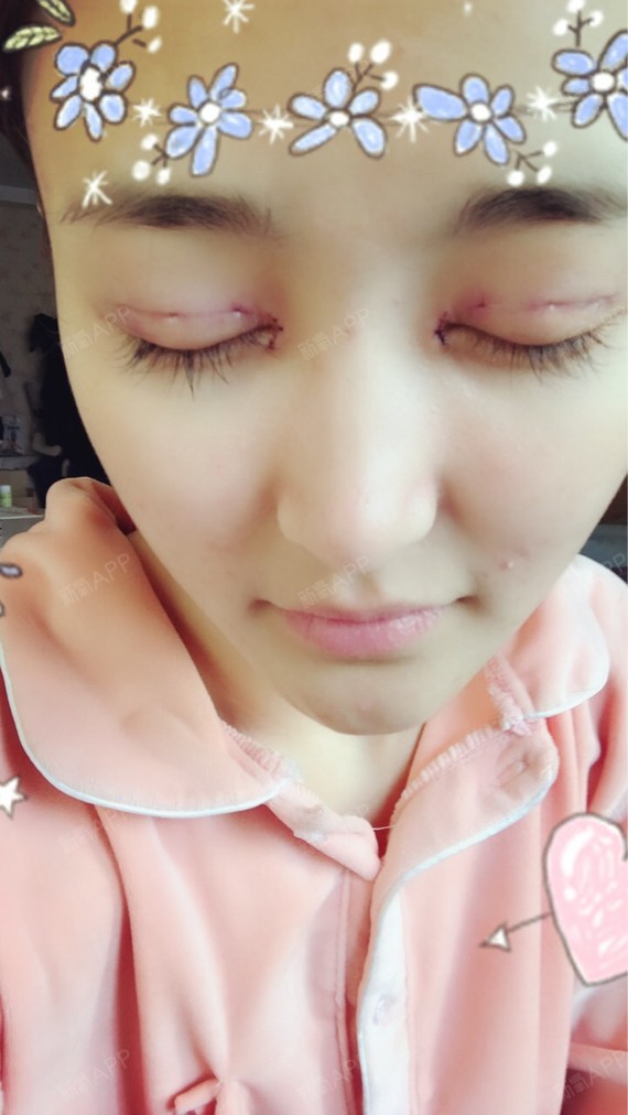 新氧- daisy77 | 眼部 | 开眼角 | 双眼皮 | 开内眼角 | 埋线双眼皮