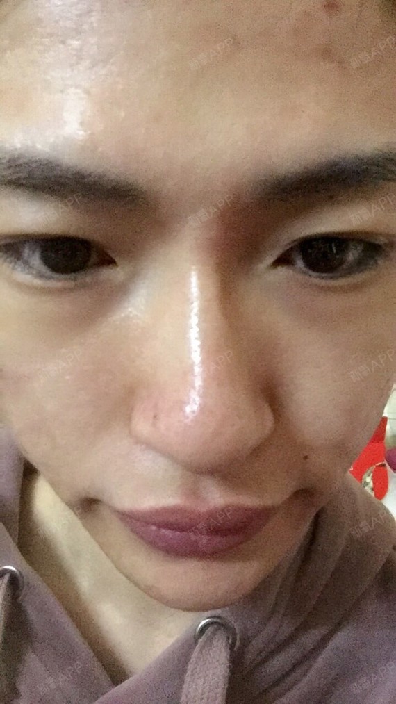 垫了山根那里,感觉看着有些不自然,不习惯吧,有些高_圈子-新氧美容