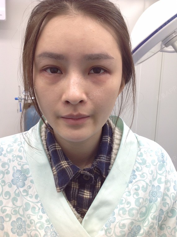 开外眼角