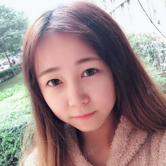 郁卒人1984面部吸脂第15天美丽日记-新氧美容