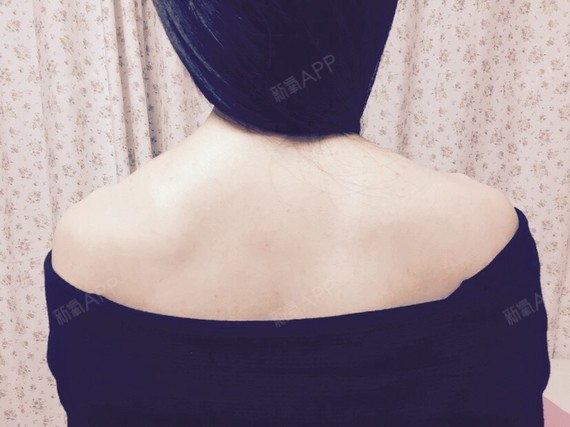 回家以后发现肩膀处已经有几处淤青了,医生交待6个小_圈子-新氧美容